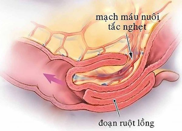 Bệnh lồng ruột ở người lớn - Triệu chứng, nguyên nhân và cách điều trị