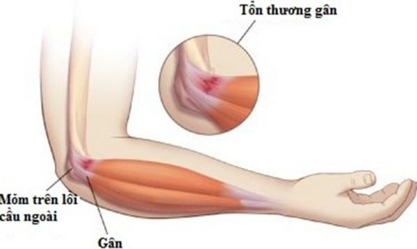 Bệnh viêm lồi cầu ngoài xương cánh tay - Triệu chứng, nguyên nhân và cách điều trị