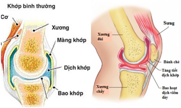 Bệnh viêm màng hoạt dịch - Triệu chứng, nguyên nhân và cách điều trị