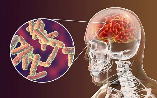 Bệnh viêm màng não - Triệu chứng, nguyên nhân và cách điều trị
