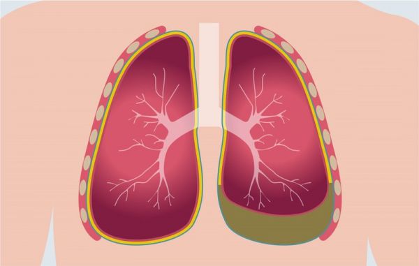 Bệnh viêm màng phổi - Triệu chứng, nguyên nhân và cách điều trị