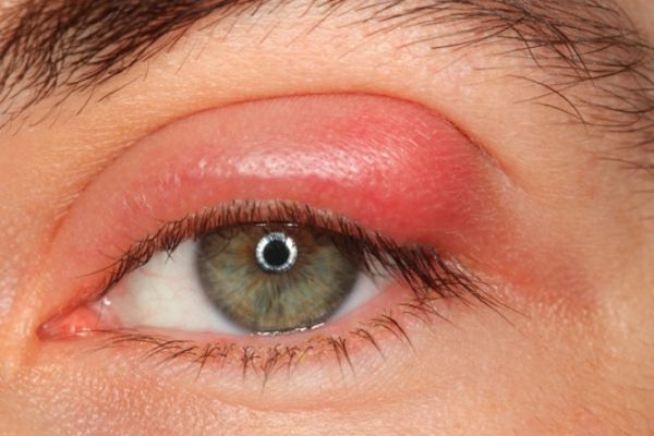 Bệnh viêm mô tế bào hốc mắt - Triệu chứng, nguyên nhân và cách điều trị