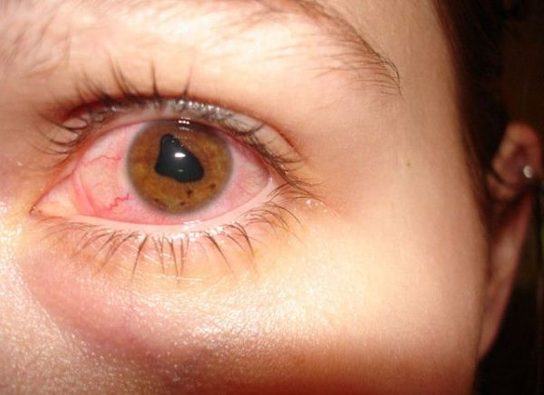 Bệnh viêm mống mắt - Triệu chứng, nguyên nhân và cách điều trị