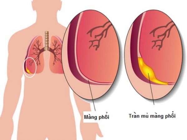 Bệnh viêm mủ màng phổi - Triệu chứng, nguyên nhân và cách điều trị