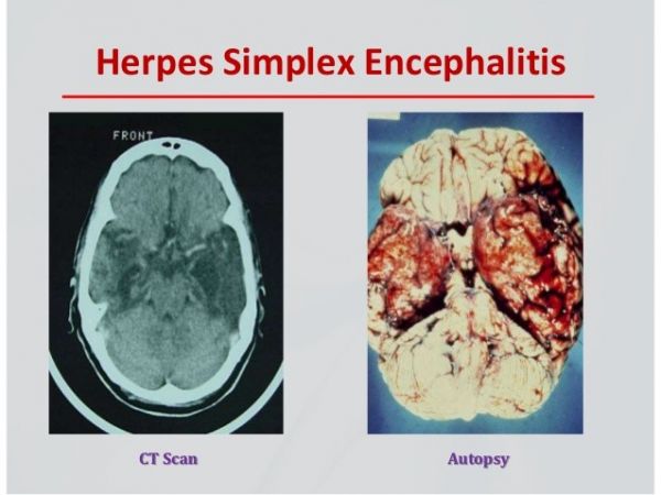 Viêm não Herpes - Triệu chứng, nguyên nhân và cách điều trị