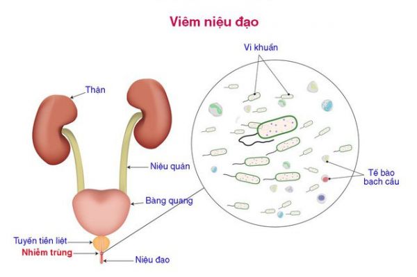 Bệnh viêm niệu đạo do lậu - Triệu chứng, nguyên nhân và cách điều trị