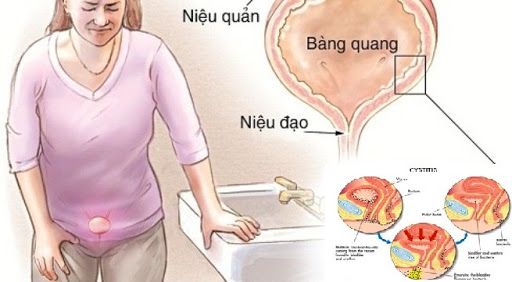 Bệnh viêm niệu đạo - Triệu chứng, nguyên nhân và cách điều trị