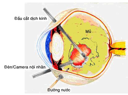 Bệnh viêm nội nhãn - Triệu chứng, nguyên nhân và cách điều trị