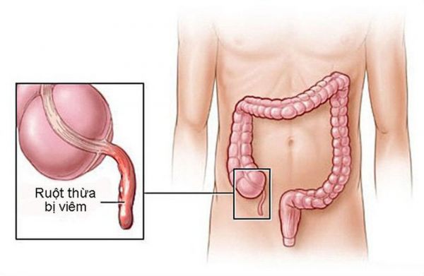 Bệnh viêm ruột thừa - Triệu chứng, nguyên nhân và cách điều trị