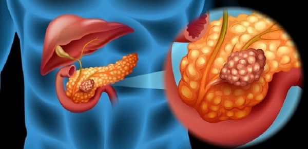 Hội chứng Zollinger-Ellison - Triệu chứng, nguyên nhân và cách điều trị