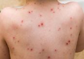 Bệnh đậu mùa - Triệu chứng, nguyên nhân và cách điều trị
