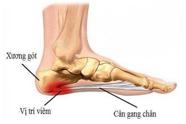 Bệnh đau gót chân - Triệu chứng, nguyên nhân và cách điều trị