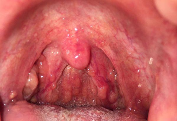 Bệnh đau họng mạn tính - Triệu chứng, nguyên nhân và cách điều trị