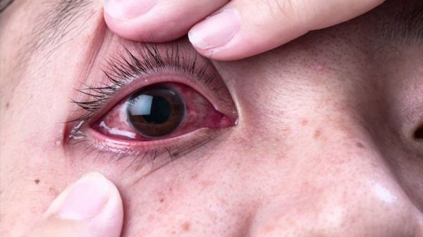Bệnh đau mắt - Triệu chứng, nguyên nhân và cách điều trị