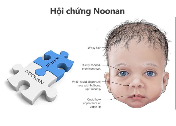 Hội chứng Noonan - Triệu chứng, nguyên nhân và cách điều trị