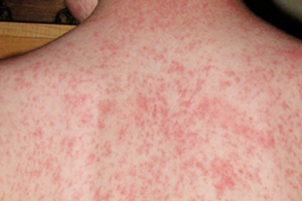 Hội chứng Reye - Triệu chứng, nguyên nhân và cách điều trị