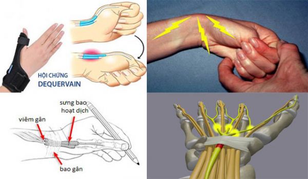 Hội chứng viêm bao gân hoạt dịch De Quervain - Triệu chứng, nguyên nhân và cách điều trị