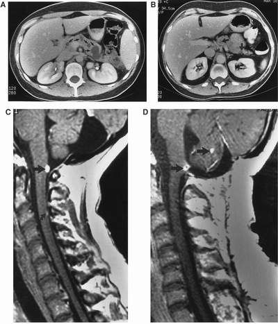 Hội chứng Von Hippel-Lindau - Triệu chứng, nguyên nhân và cách điều trị