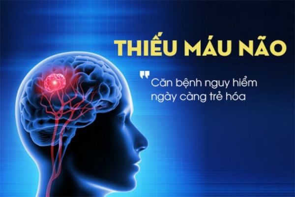 Bệnh cơn thiếu máu não thoáng qua - Triệu chứng, nguyên nhân và cách điều trị