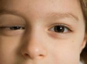 Hội chứng Horner - Triệu chứng, nguyên nhân và cách điều trị