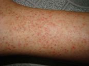 Hội chứng kháng thể kháng phospholipid - Triệu chứng, nguyên nhân và cách điều trị