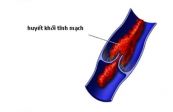 Bệnh viêm tĩnh mạch huyết khối - Triệu chứng, nguyên nhân và cách điều trị