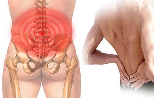 Bệnh đau thắt lưng - Triệu chứng, nguyên nhân và cách điều trị