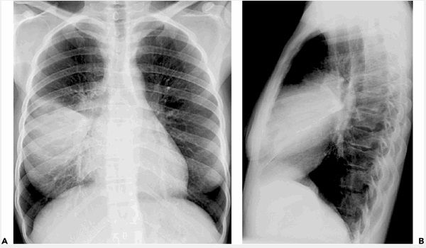 Hội chứng Löffler - Triệu chứng, nguyên nhân và cách điều trị