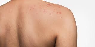 Hội chứng Muckle-Wells - Triệu chứng, nguyên nhân và cách điều trị