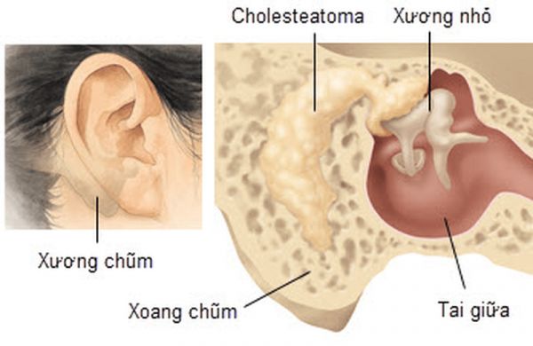 Bệnh viêm tai xương chũm - Triệu chứng, nguyên nhân và cách điều trị