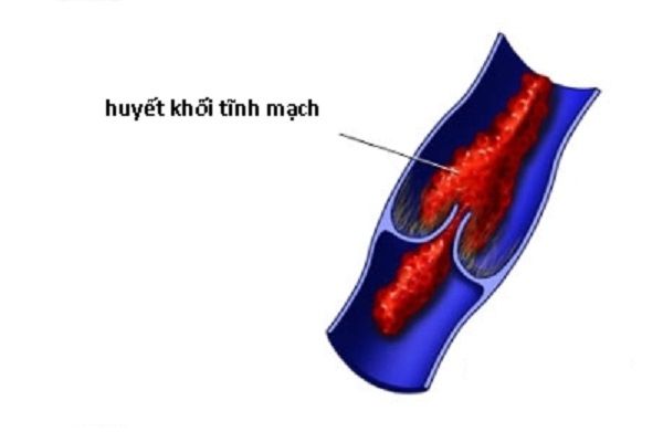 Bệnh viêm tĩnh mạch huyết khối - Triệu chứng, nguyên nhân và cách điều trị