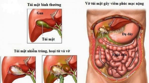 Bệnh viêm túi mật cấp tính - Triệu chứng, nguyên nhân và cách điều trị