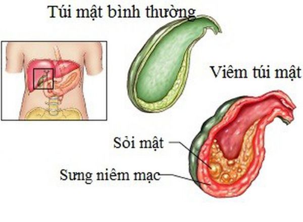 Bệnh viêm túi mật - Triệu chứng, nguyên nhân và cách điều trị