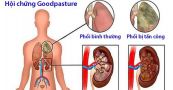 Hội chứng Goodpasture - Triệu chứng, nguyên nhân và cách điều trị