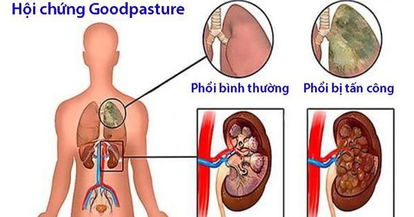 Hội chứng Goodpasture - Triệu chứng, nguyên nhân và cách điều trị