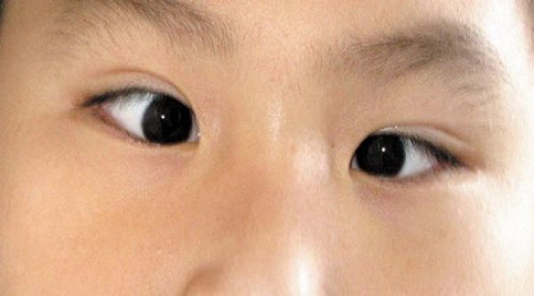 Bệnh lác mắt - Triệu chứng, nguyên nhân và cách điều trị