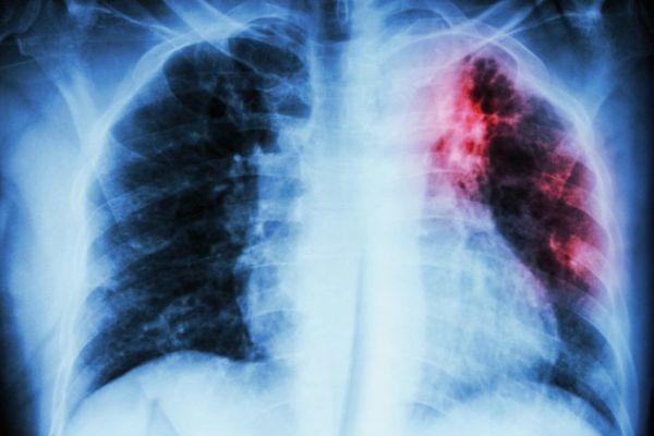 Bệnh lao phổi - Triệu chứng, nguyên nhân và cách điều trị