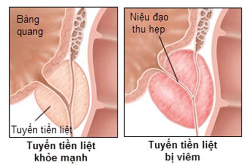 Bệnh viêm tuyến tiền liệt - Triệu chứng, nguyên nhân và cách điều trị