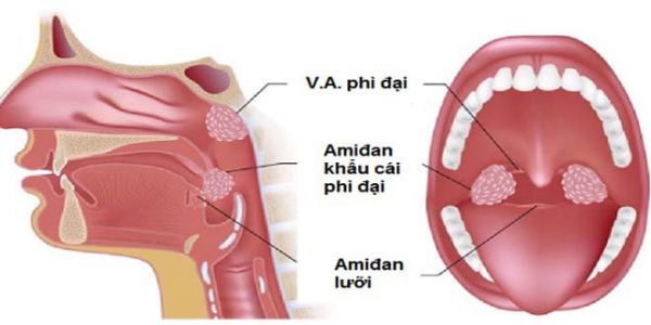 Bệnh viêm VA - Triệu chứng, nguyên nhân và cách điều trị