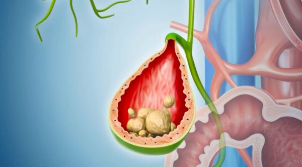 Bệnh viêm xơ chai đường mật - Triệu chứng, nguyên nhân và cách điều trị