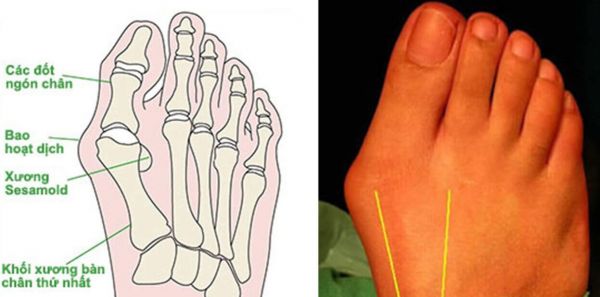 Bệnh đau xương bàn chân - Triệu chứng, nguyên nhân và cách điều trị