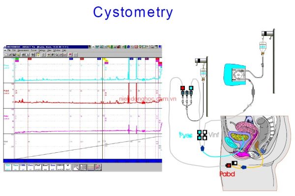 Đo áp lực bàng quang - Quy trình thực hiện và những lưu ý cần biết