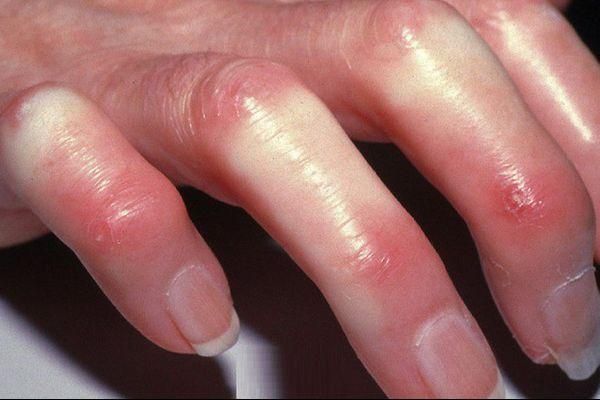 Hội chứng CREST - Triệu chứng, nguyên nhân và cách điều trị