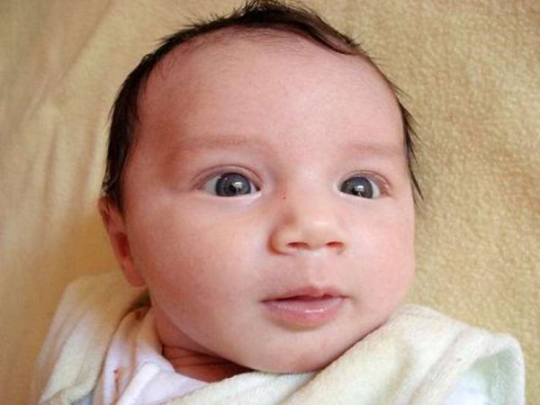 Hội chứng Crouzon - Triệu chứng, nguyên nhân và cách điều trị