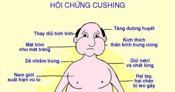 Hội chứng Cushing - Triệu chứng, nguyên nhân và cách điều trị