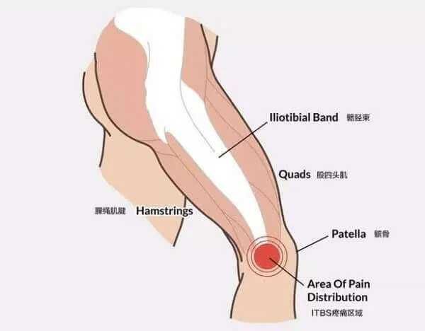 Hội chứng dải chậu chày - Triệu chứng, nguyên nhân và cách điều trị