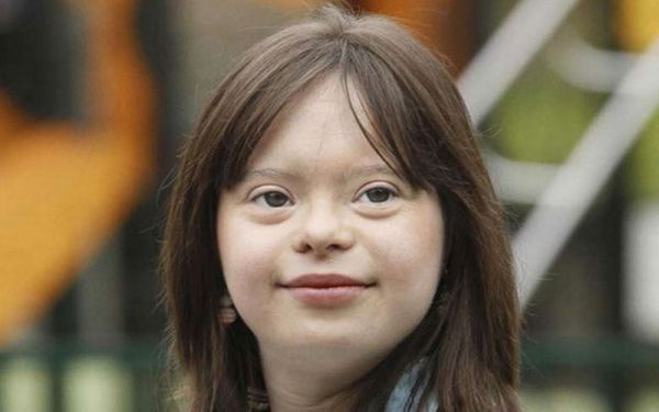 Hội chứng Down - Triệu chứng, nguyên nhân và cách điều trị