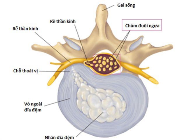 Hội chứng đuôi ngựa - Triệu chứng, nguyên nhân và cách điều trị