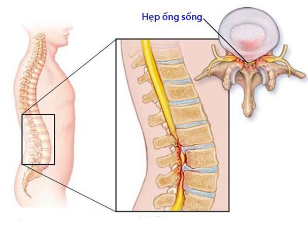 Hội chứng chèn ép tủy - Triệu chứng, nguyên nhân và cách điều trị