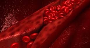 Hội chứng thuyên tắc mỡ - Triệu chứng, nguyên nhân và cách điều trị